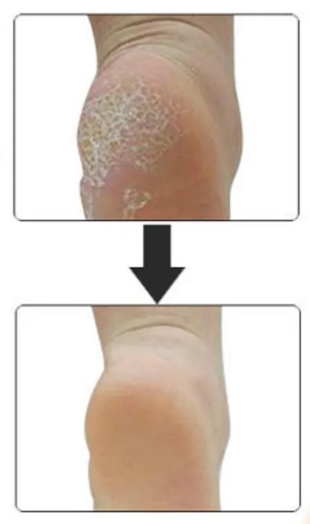 Heel Spur Relief -  Massage Gel Cup Pads for Plantar Fasciitis